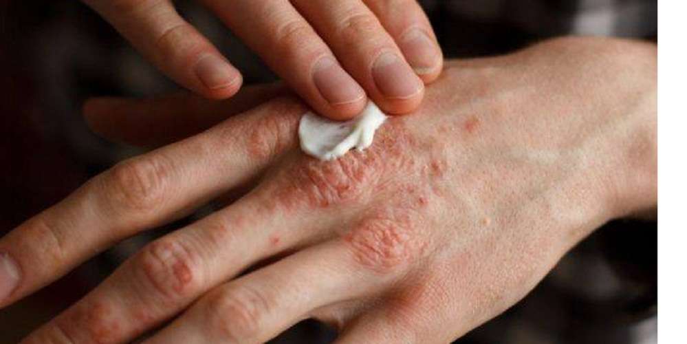 मधेस प्रदेशमा सबैभन्दा धेरै कुष्ठरोगी