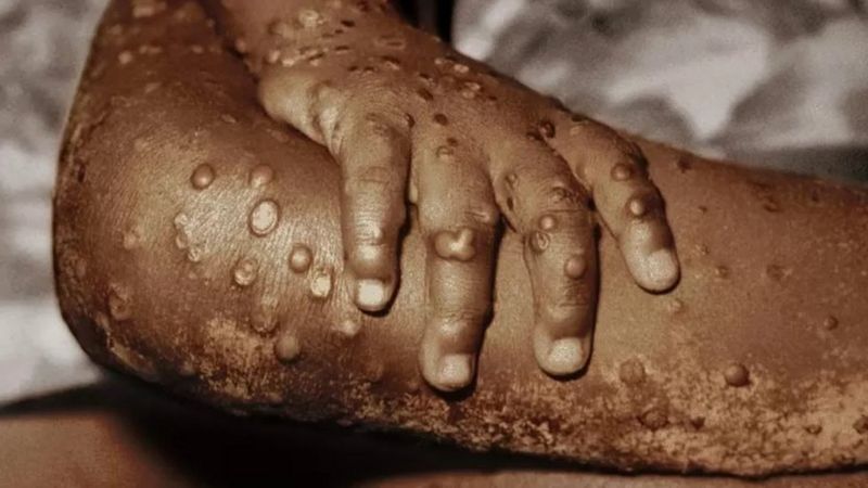 भारतमा ९ जनामा मंकीपक्स संक्रमण